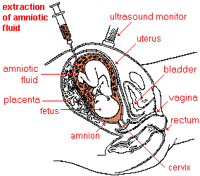 drawing of the amniocentesis procedure--amniotic fluid is extracted with a hypodermic needle inserted through the abdomen; the needle is guided with the aid of an ultrasound monitor