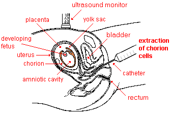 drawing of the chorionic villi biopsy process--a flexible plastic catheter tube is inserted through the vagina into the uterus guided by an ultrasound monitor and a small amount of the chorion is sucked off