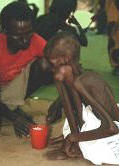 photo of an emaciated African boy with severe marasmus at a feeding station