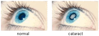photo of a normal eye and another with a cataract